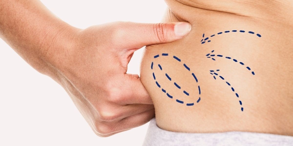 Liposuction Cost Talk: How to Approach It Confidently