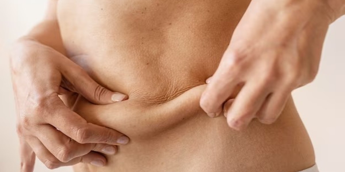 How Does a Tummy Tuck Address Loose Skin?