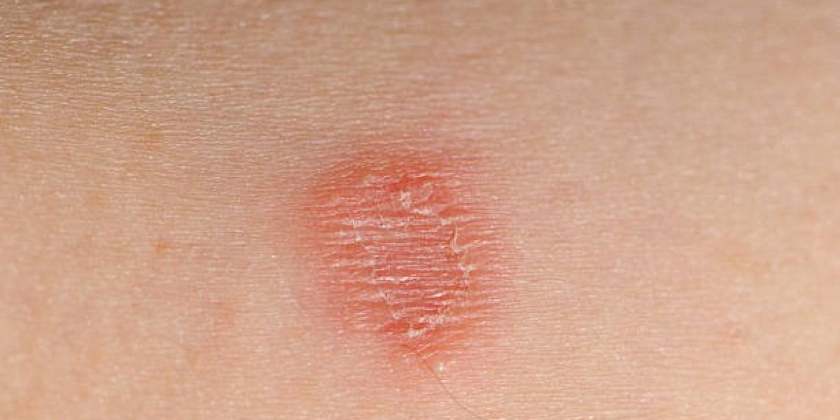Unlock Strategic Insights on Ringworm Treatment Market Size and Antifungal Drug Trends