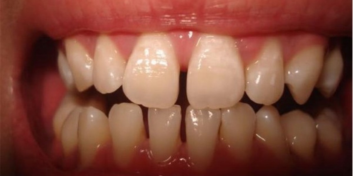 Trám răng giá bao nhiêu? Bảng giá chi tiết và những điều cần biết