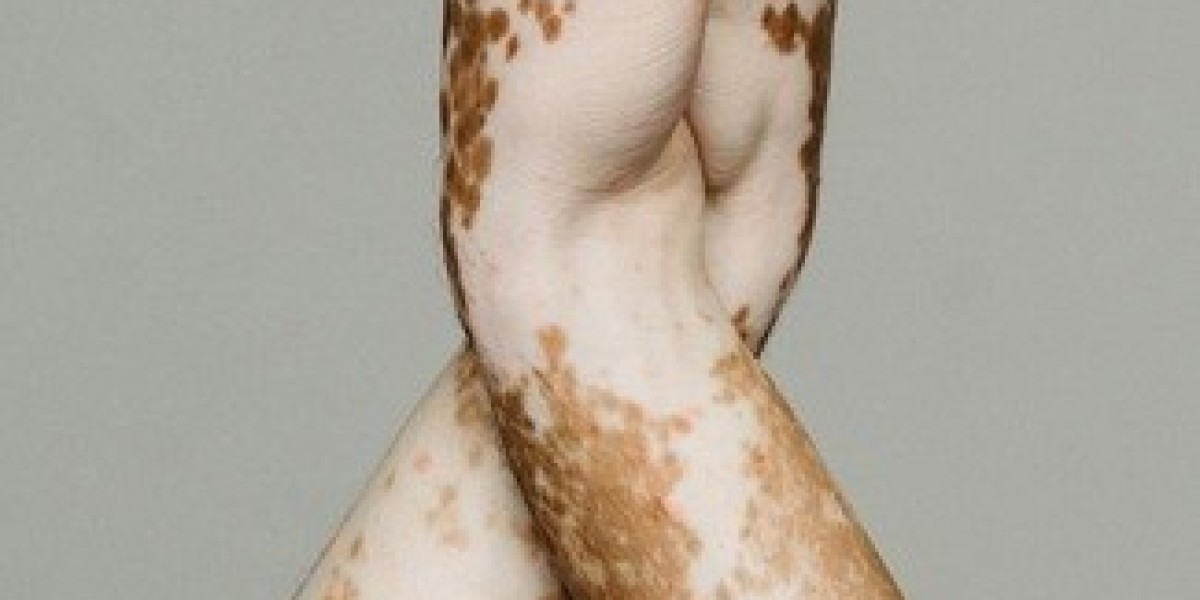 Is Vitiligo Curable?