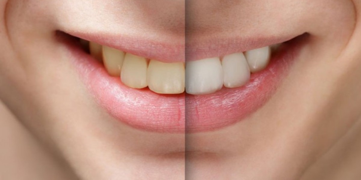 Trước và sau khi trồng răng implant có gì khác biệt?