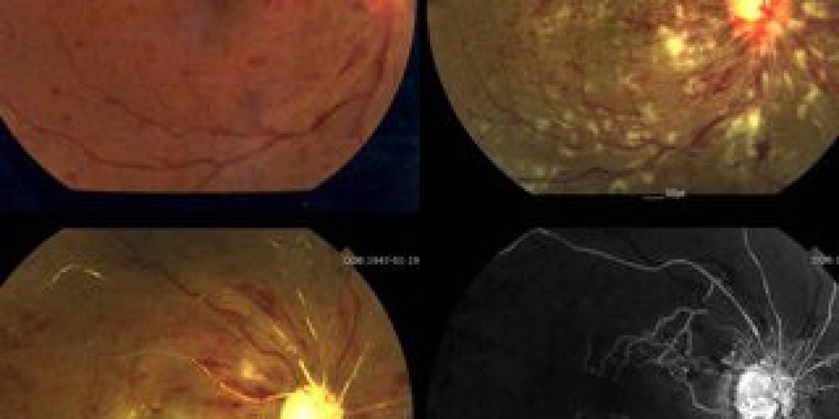 Retinal Vein Occlusion Market Size, Trends, and Growth Analysis 2025-2032