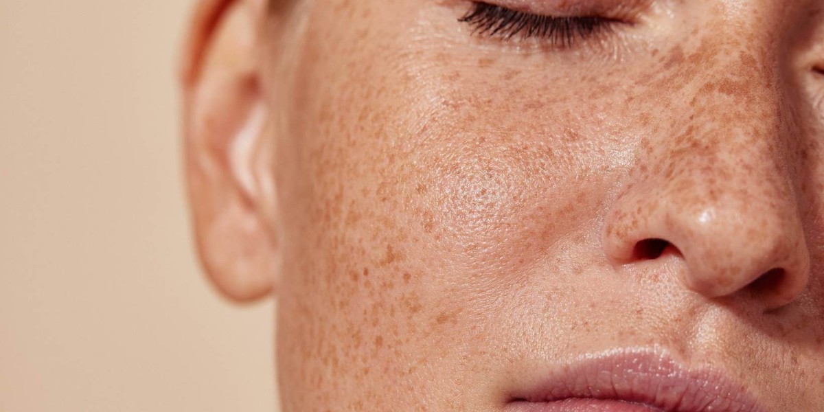 Cosmelan Peel Targets Melasma and Dark Spots