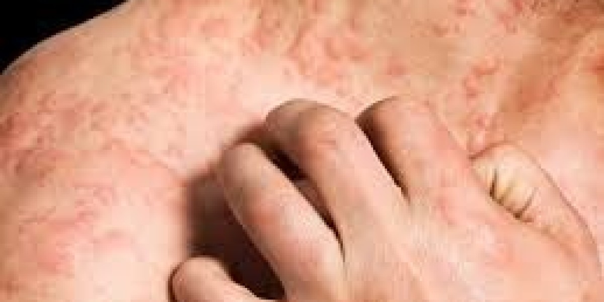 Chronic Pruritus Therapeutics Market Outlook – Global Forecast & Trends