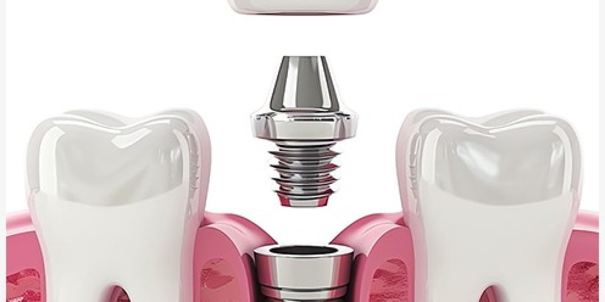 Tổng Chi Phí Trồng Răng Implant Hàm Số 7 Giá Bao Nhiêu? 