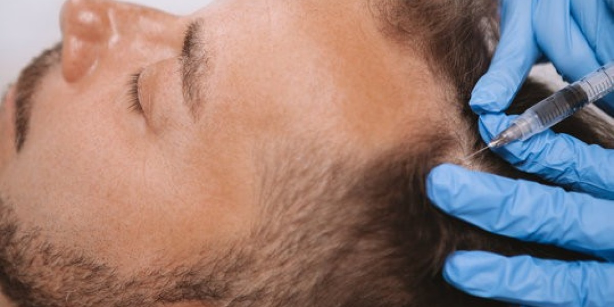 Scalp Micro Pigmentation: A Smart Solution for Baldness & Thin Hair