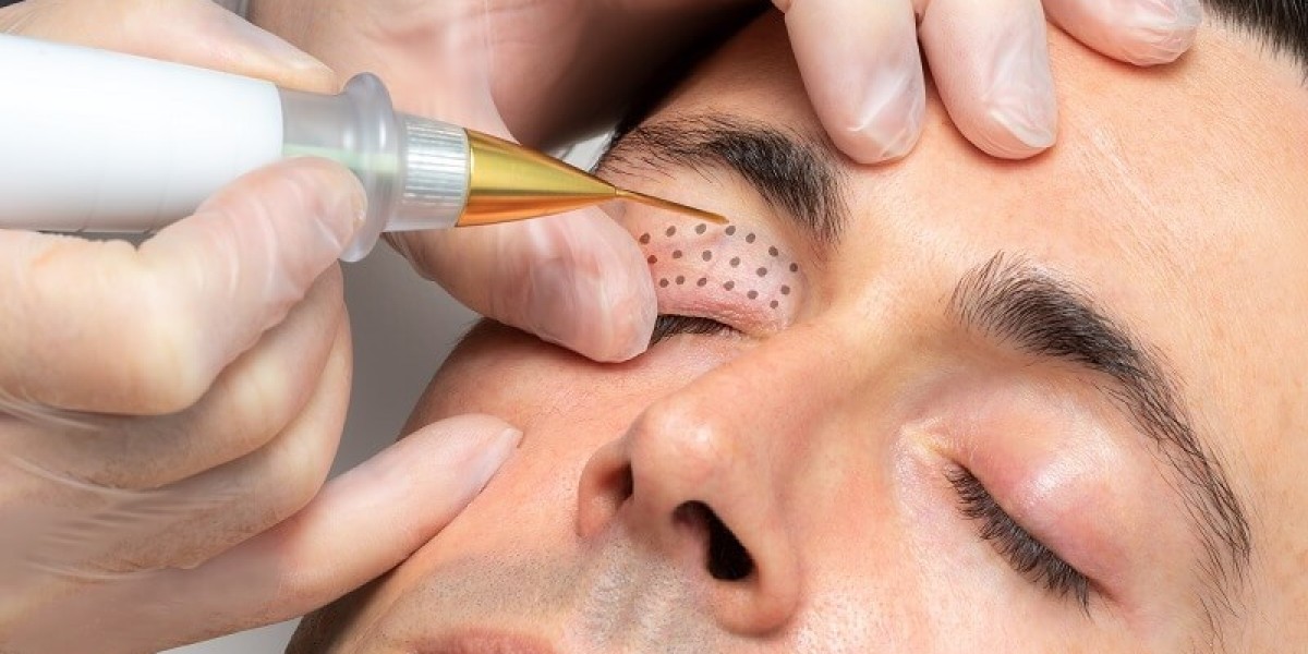 Does Plasma Pen Work on Upper Eyelids Safely?