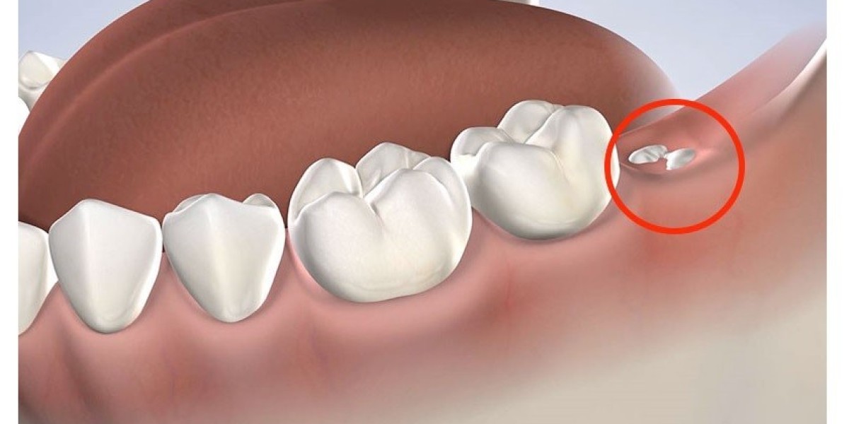 Nhổ răng khôn hàm trên có nguy hiểm không? Tư vấn từ chuyên gia Răng Hàm Mặt