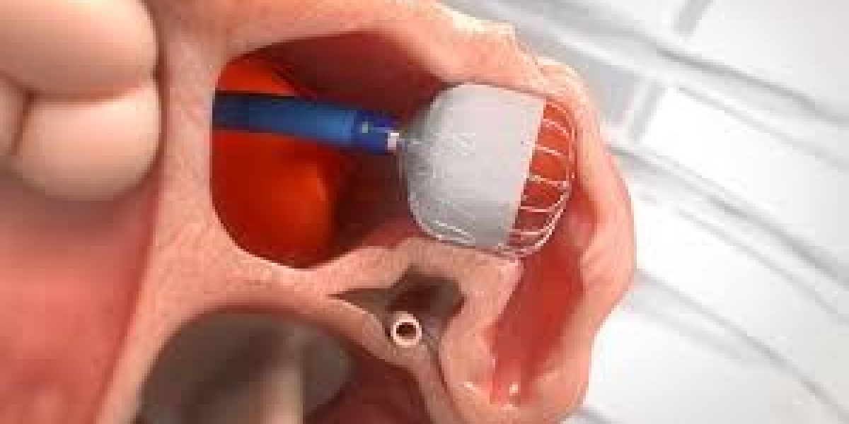 Atrial Fibrillation Device Market Dynamics: Exploring Key Forces Shaping Global Expansion