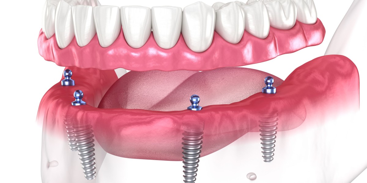The Power of a Smile Begins with Dental Implants in Dubai