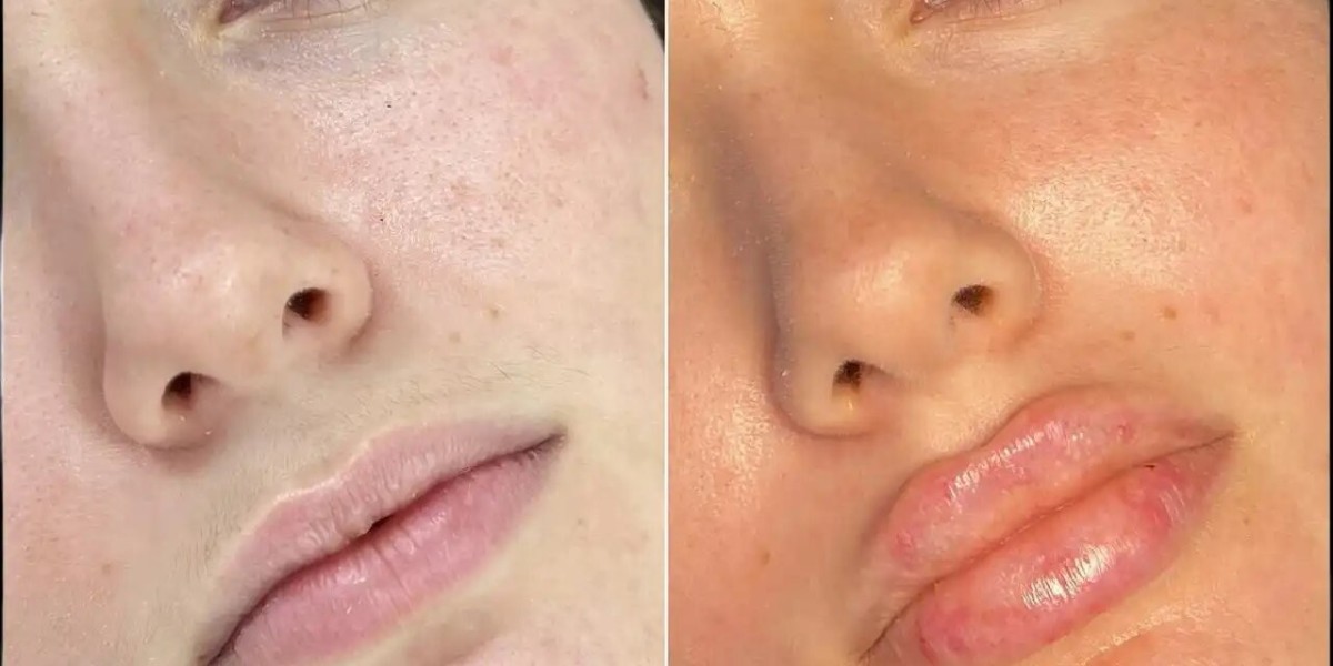 Best Plastic Surgeon in dubai for Under-Eye Fillers Treatments
