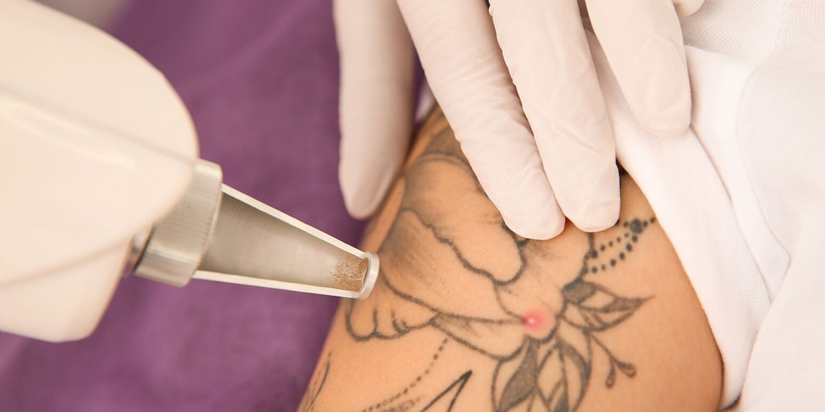 The Ink Exit Plan: Laser Tattoo Removal That Delivers