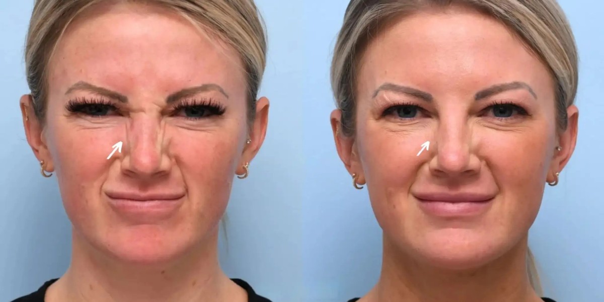 Best Doctors in Dubai for Botox: Why They’re the Right Choice