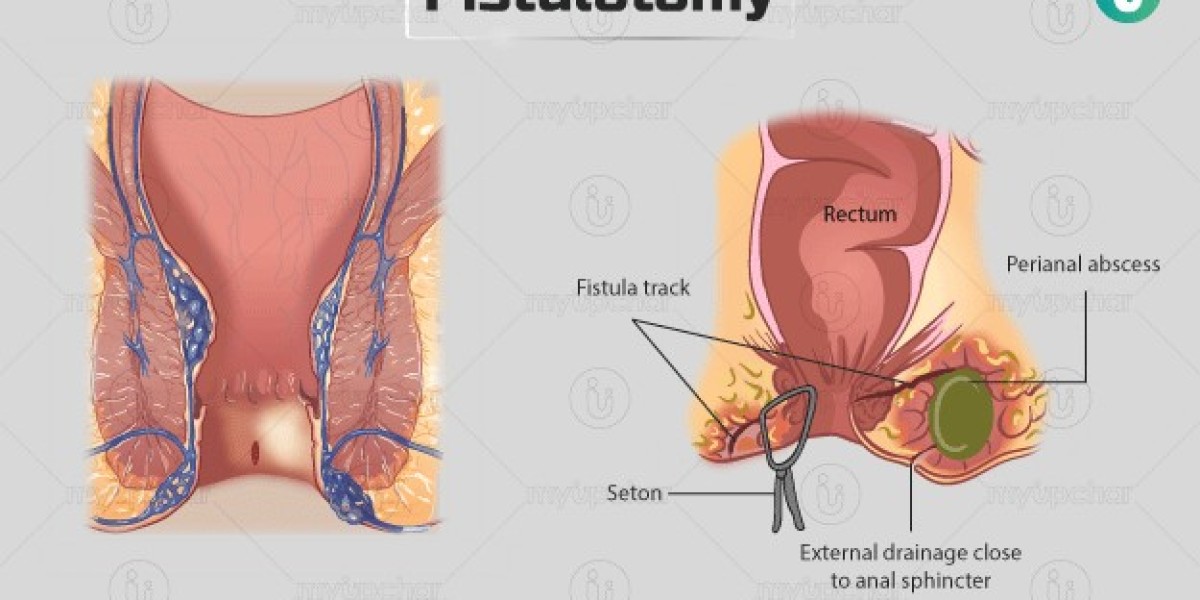 Fistulotomy: Preparation, Procedure, Recovery & Long-Term Care