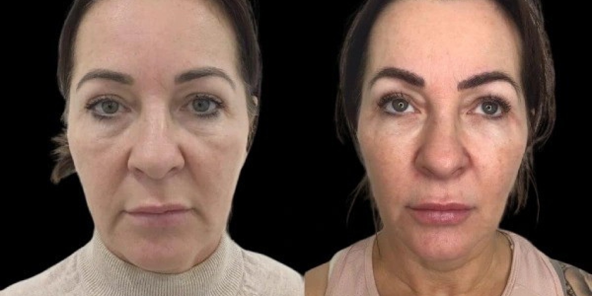 Best Doctors in Dubai for Profhilo Skin Rejuvenation