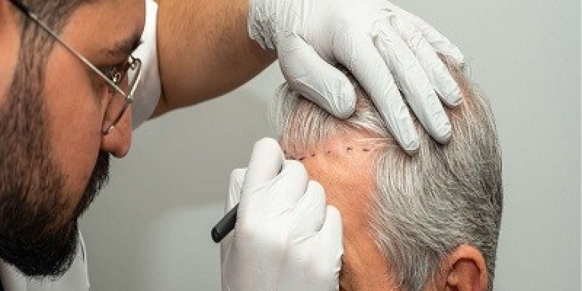 How to Prepare for Your Hair Transplant in Islamabad – Tips from Experts