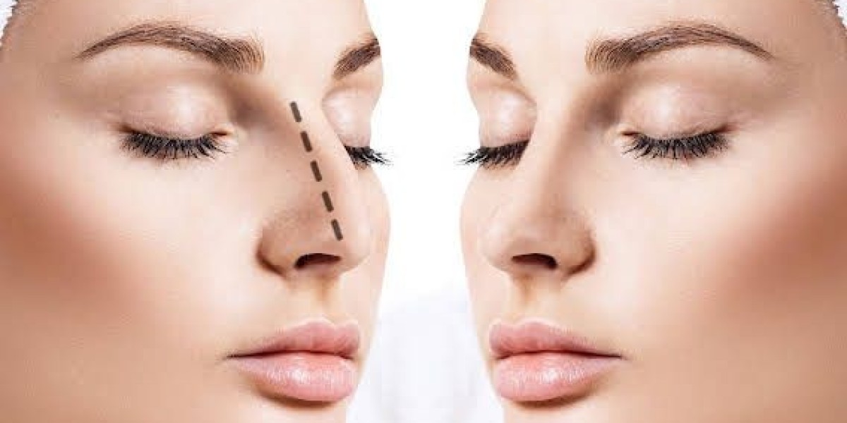 Rhinoplasty for Crooked Nose Riyadh?