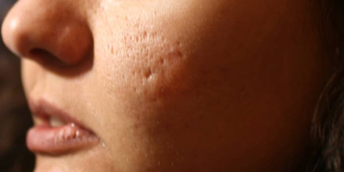 Large Pores: Innovative Minimizing Therapies