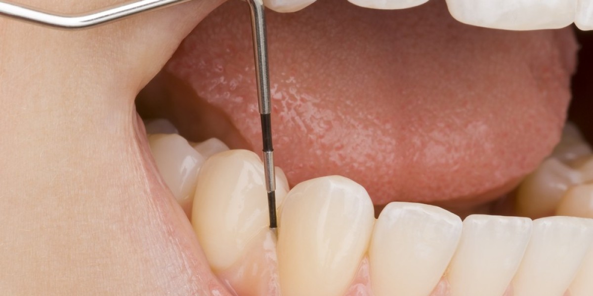 Gingivectomy vs. Scaling and Root Planing: Understanding Your Options