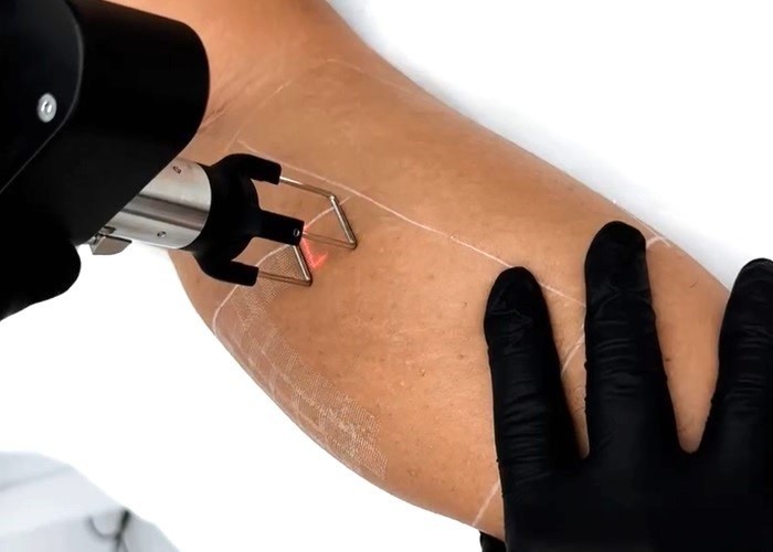 Laser Stretch Marks Treatment in Dubai