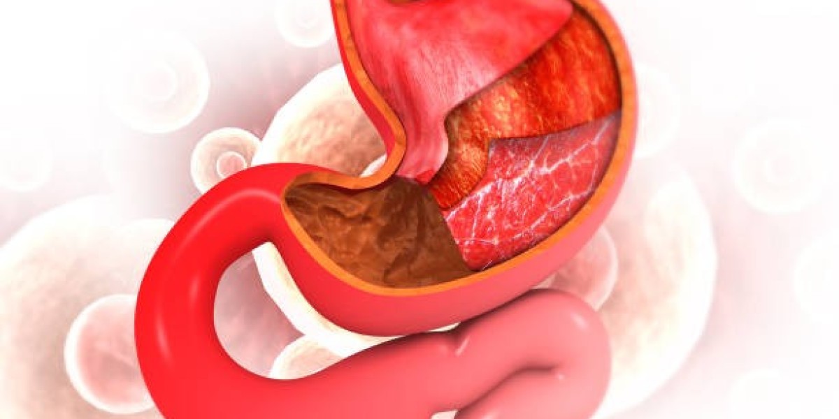 Can Gastric Balloon Help With Diabetes Management in Riyadh?