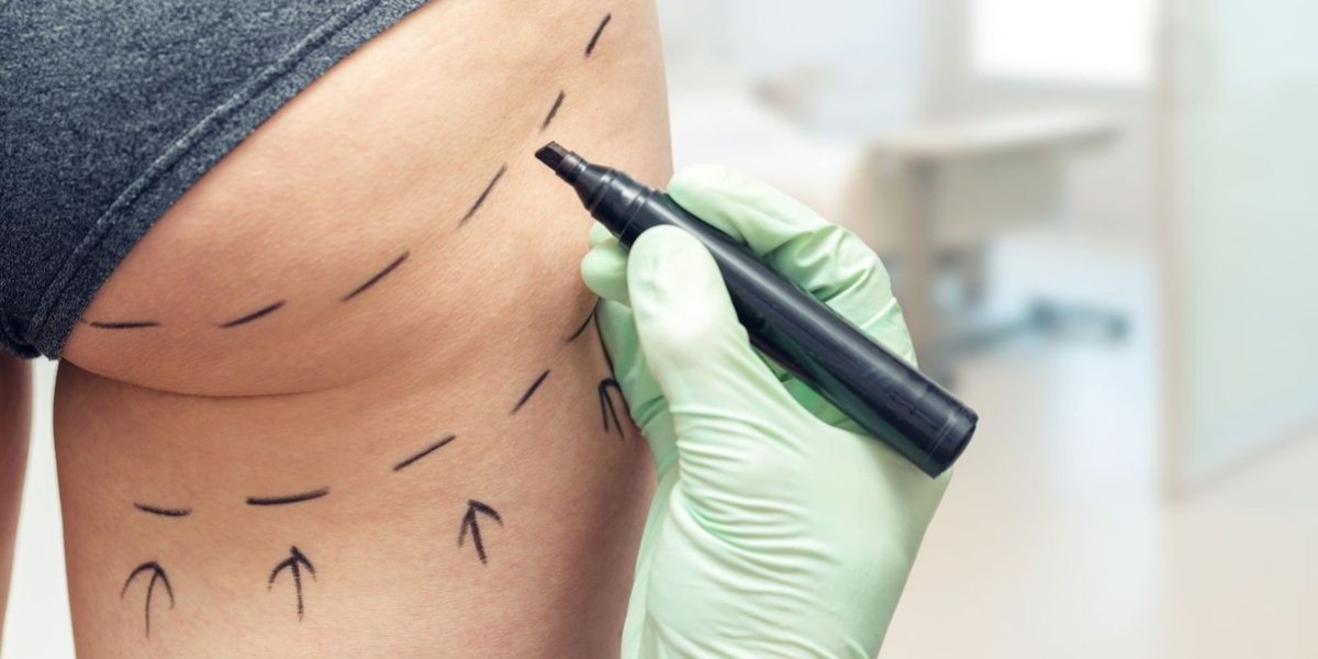 Thigh Lift Surgery Before & After in Riyadh: A Transformative Journey