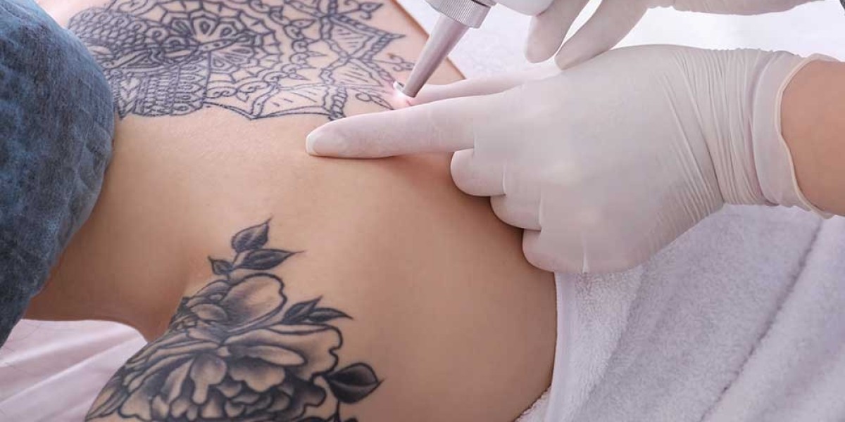 How Many Sessions for Laser Tattoo Removal?