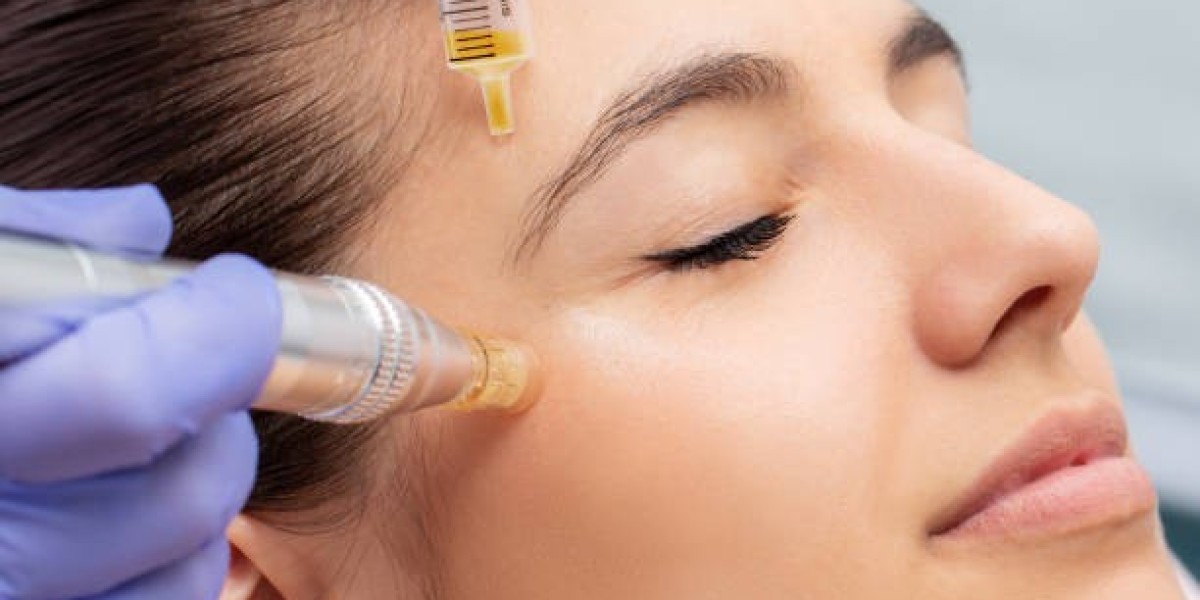 Mesotherapy Dubai: Benefits for Hair Loss