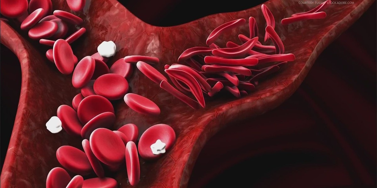 Sickle Cell Disease Treatment Market Size, Growth, and Strategic Outlook 2025-2032