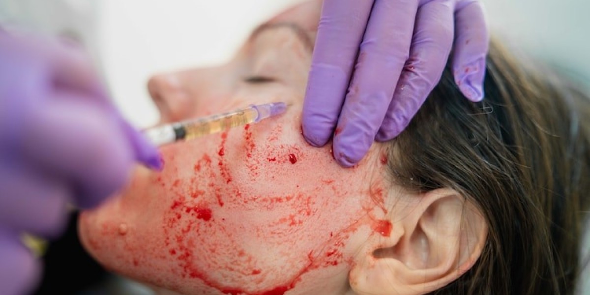 Can Vampire Facials Help with Hyperpigmentation?