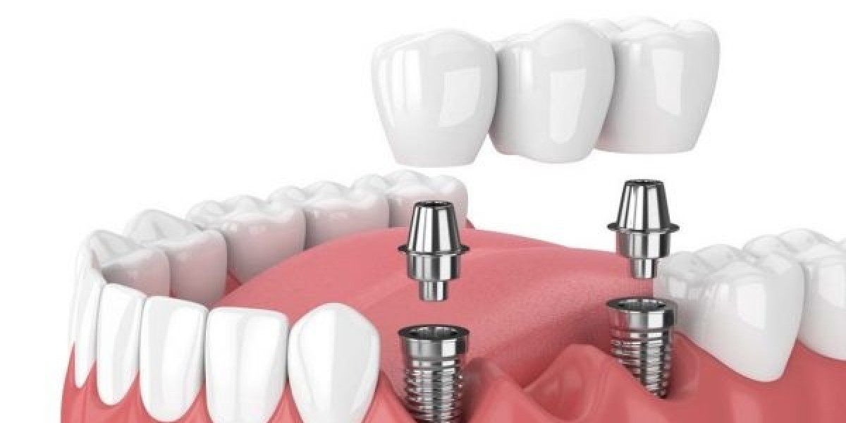 Trồng răng implant là gì? Giải pháp phục hình răng hiện đại