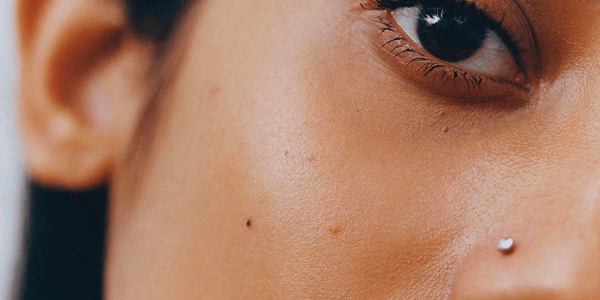 Can Skin Whitening Treatments Lighten Dark Spots?