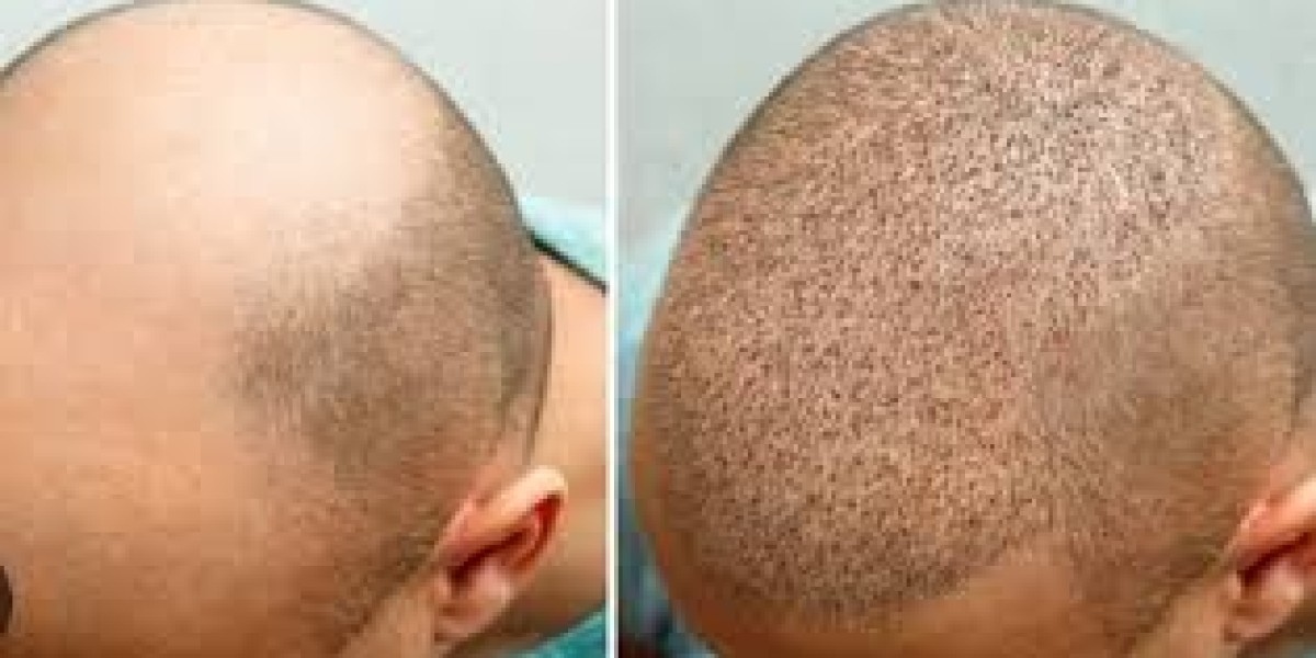 زراعة الشعر بالتقسيط في الرياض: الحل المثالي للجميع