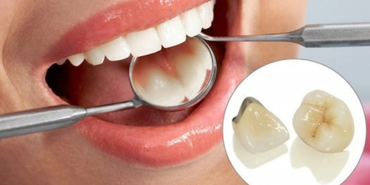 Trường hợp nào bắt buộc phải làm răng sứ thẩm mỹ?
