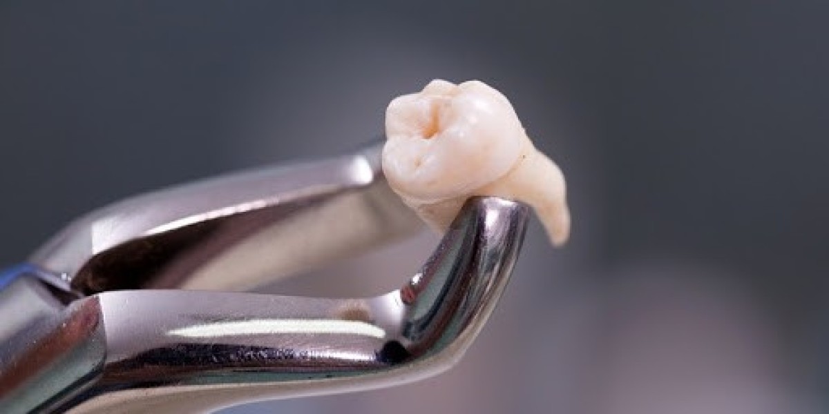 Nhổ răng khôn bảo hiểm y tế: Cập nhật quy định mới nhất
