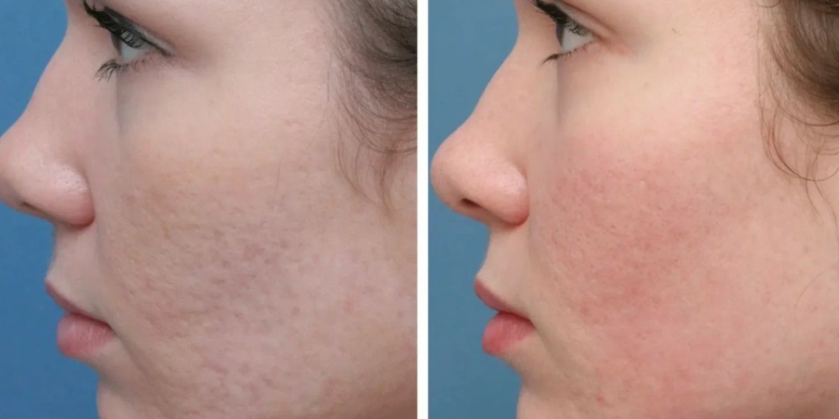 How to Choose the Right Laser Clinic for Scars in Riyadh