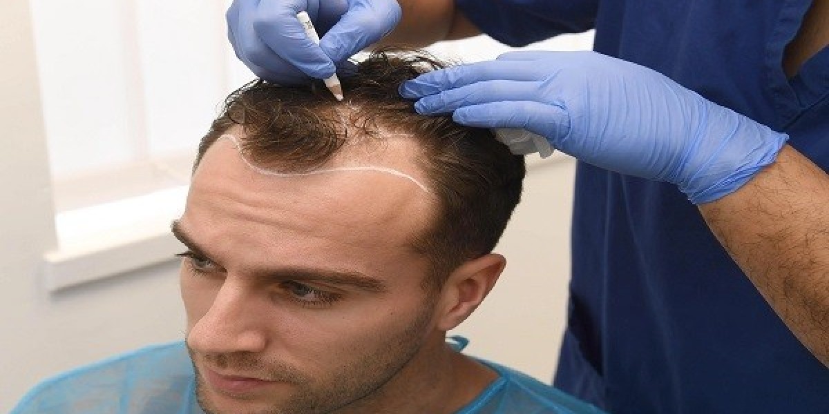 What Not to Do After a Hair Transplant in Islamabad