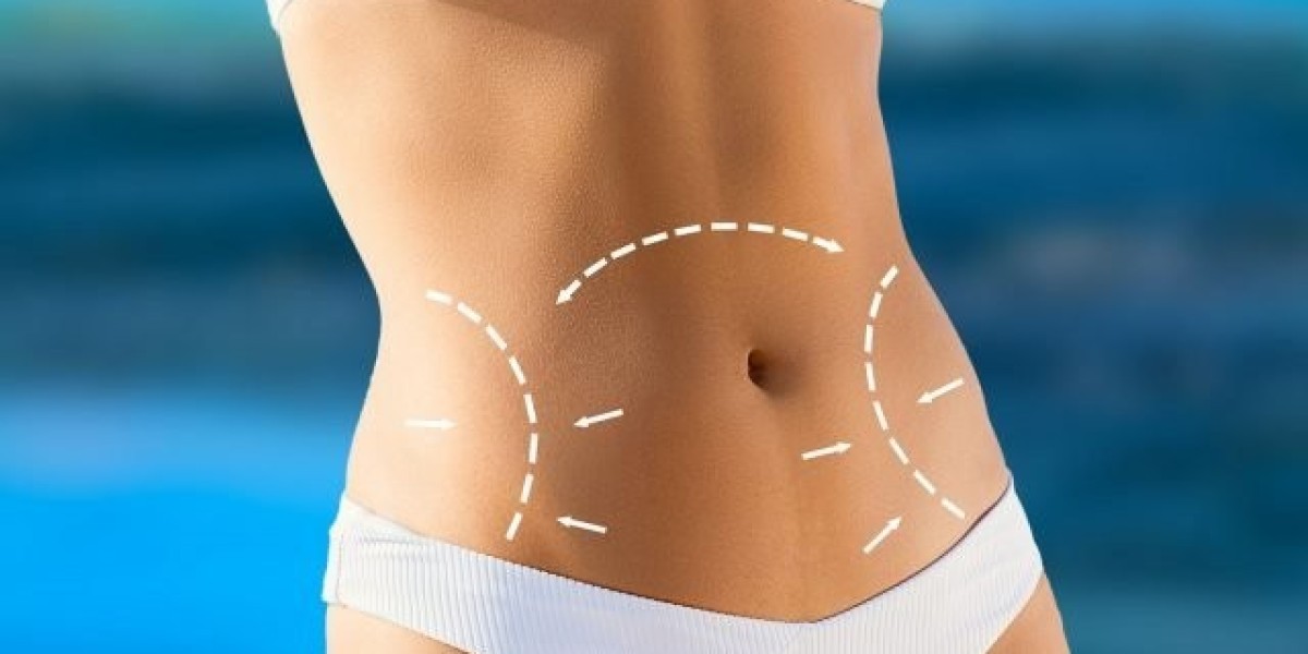 What is the Recovery Like After a Tummy Tuck in Islamabad?
