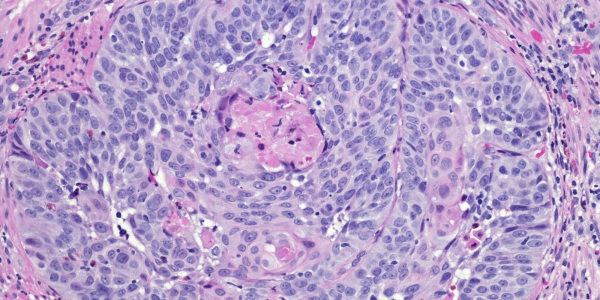 Advanced Non-Squamous and Squamous NSCLC Market Growth and Dynamics: 2025-2032