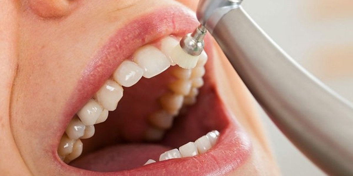 How Often Should You Schedule Teeth Polishing for a Sparkling Smile?