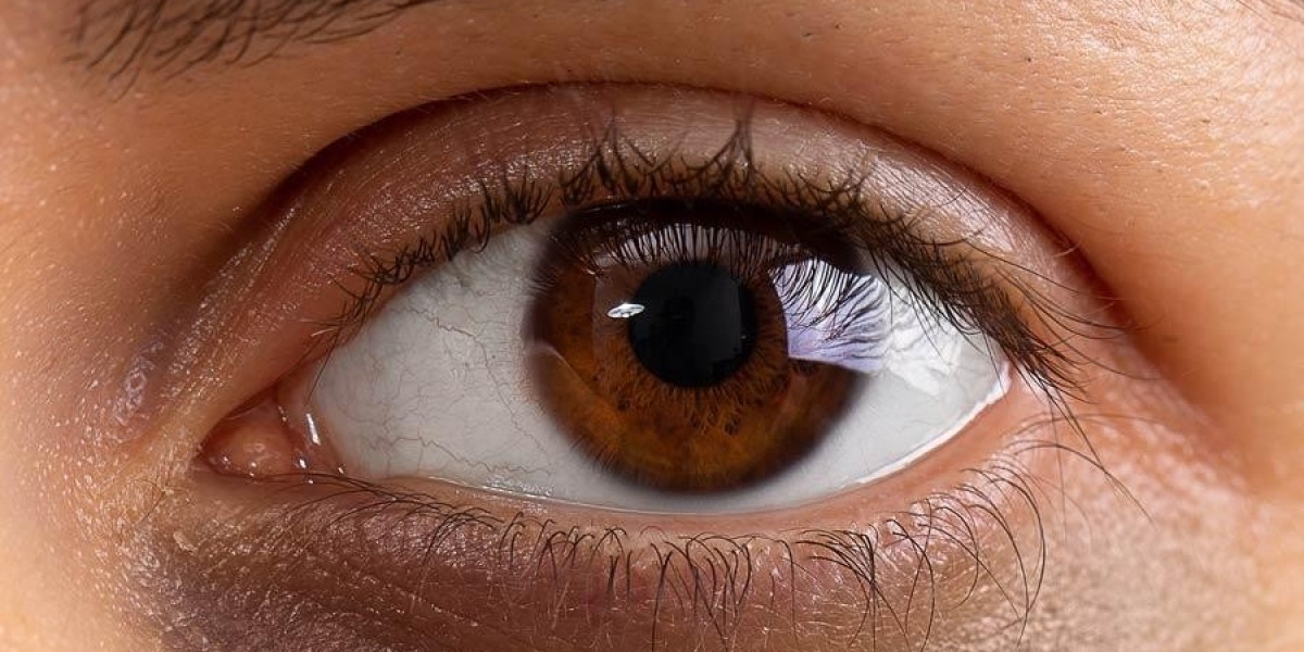 What Causes Dark Circles Under The Eyes?