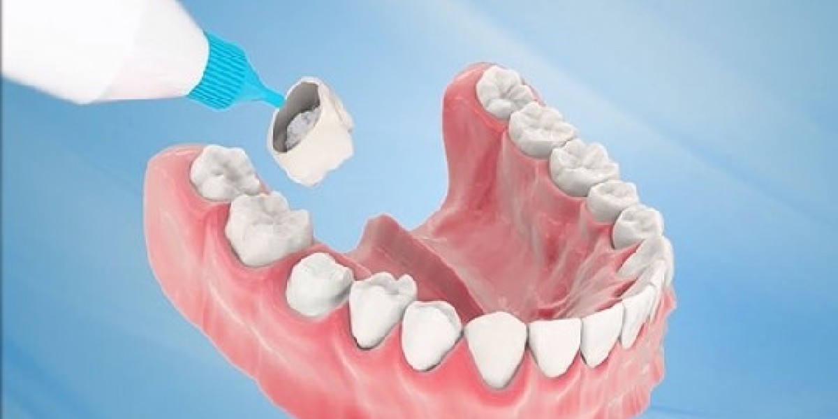 Răng bọc sứ: Giải pháp phục hình tối ưu cho nụ cười tự tin