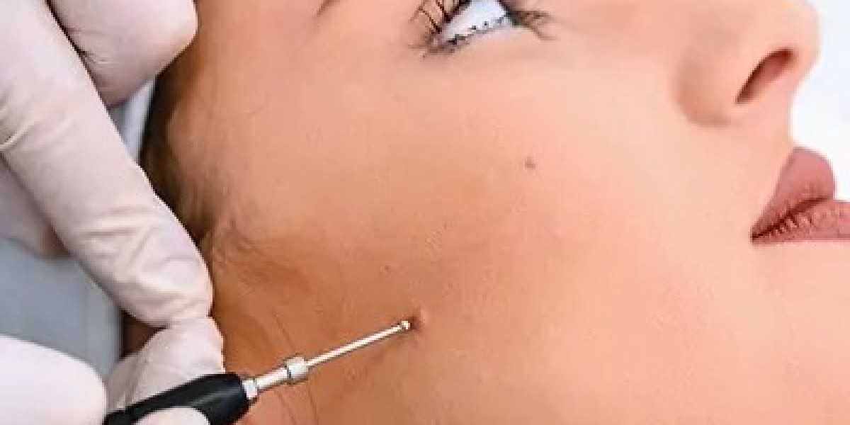Birthmark Removal in Dubai for Port Wine Stains and Café-au-Lait Marks