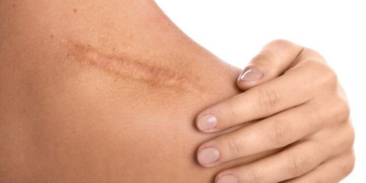Does Laser Scar Removal Hurt During the Procedure?
