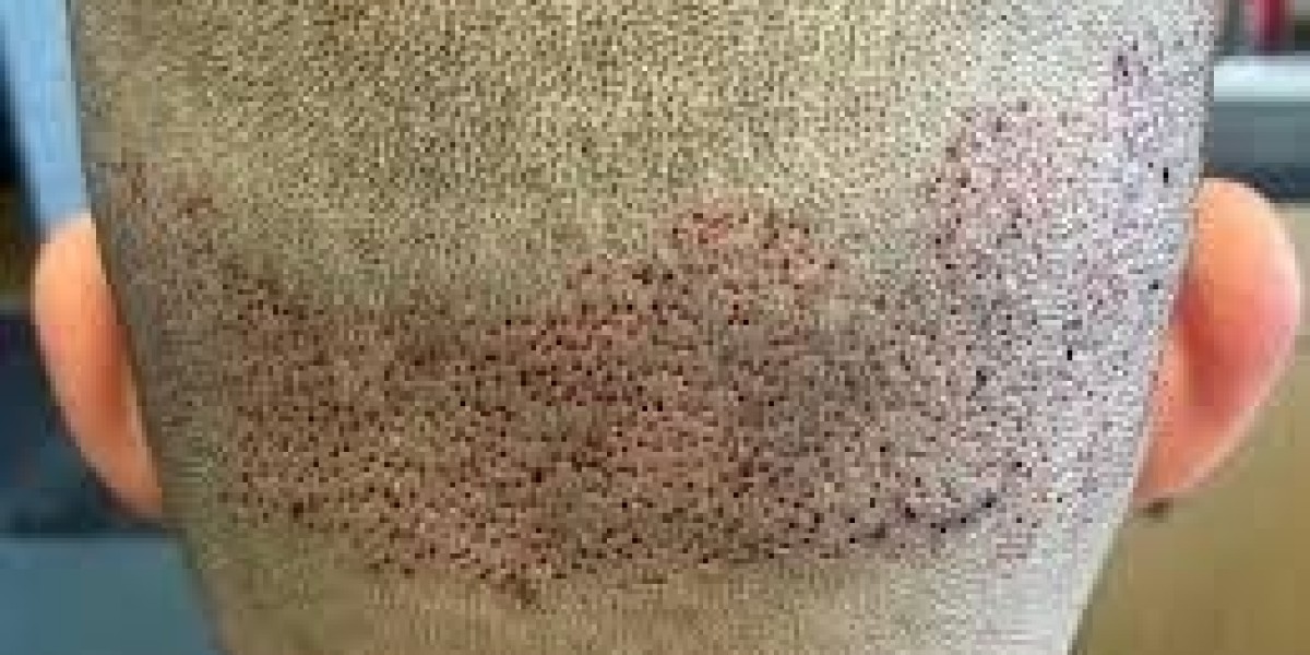Are There Any Scars After Male Hair Transplant?