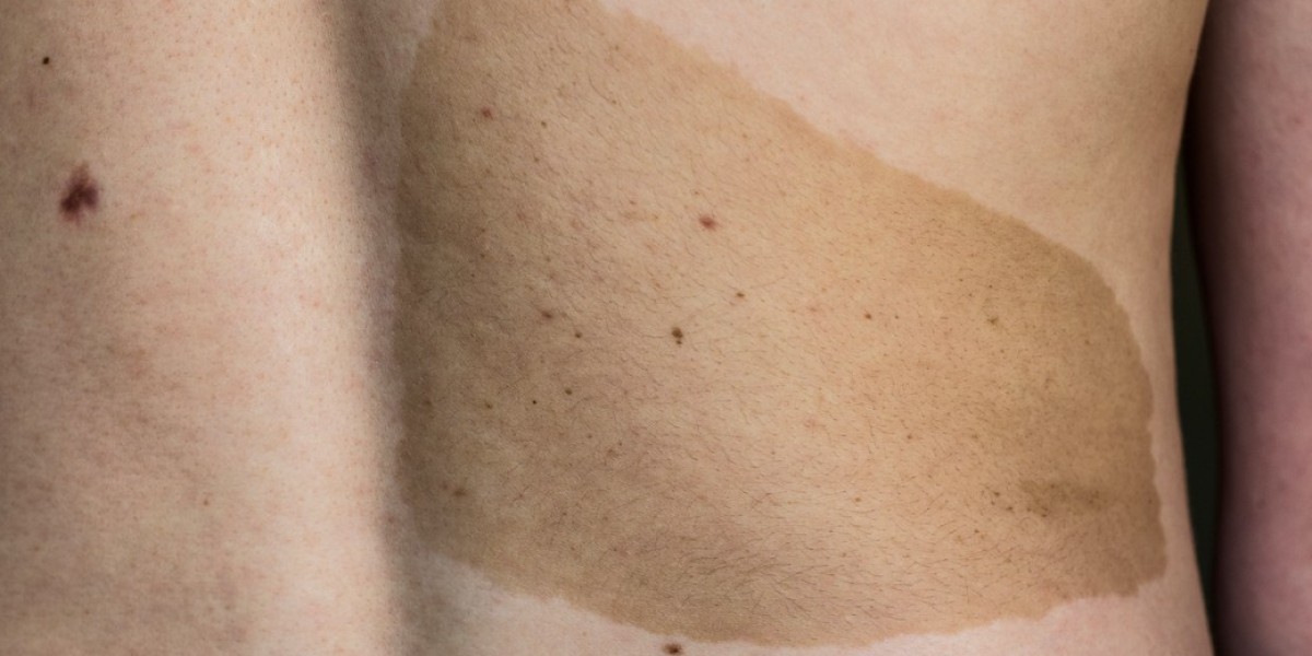 How Many Sessions Are Needed For Birthmark Removal?