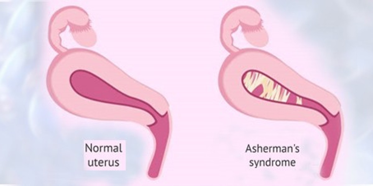 Ashermans Syndrome Market Growth Demand Statistics and Application Insights
