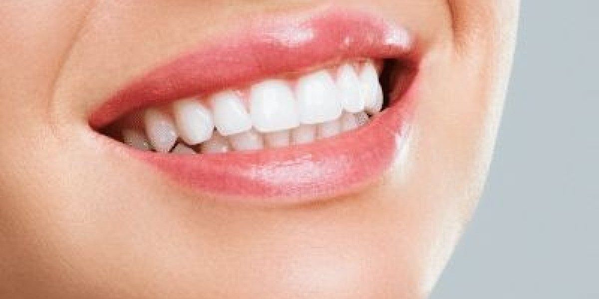 Expert Teeth Polishing Services Riyadh