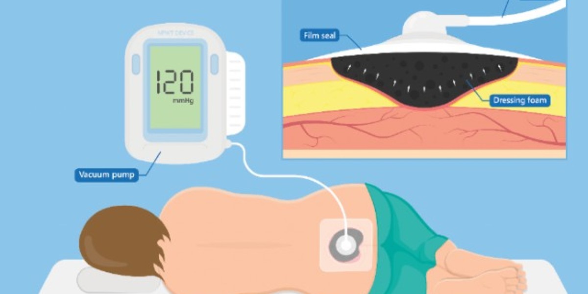 Negative Pressure Wound Therapy Market Set for Strong Growth Through 2035, Led by Global Healthcare Leaders